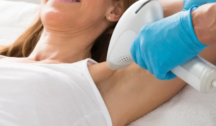 Laser Hair Removal