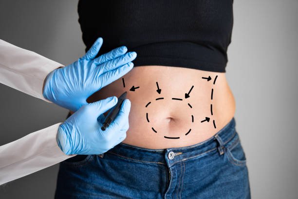 Abdominoplasty Obesity Surgery. Aesthetic Abdominal Fat Liposuction