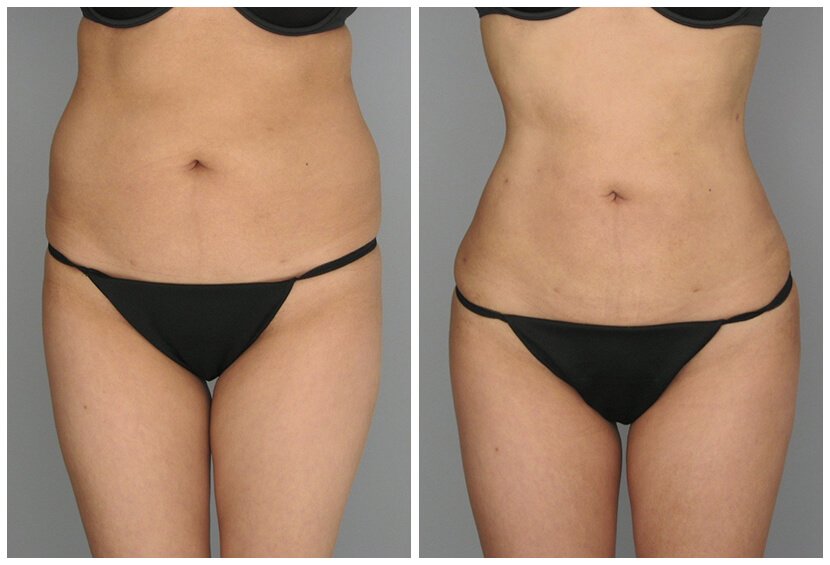 Fat-Transfer-Before-After-O.S-Q.U