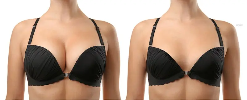 model-before-and-after-breast-reduction-example